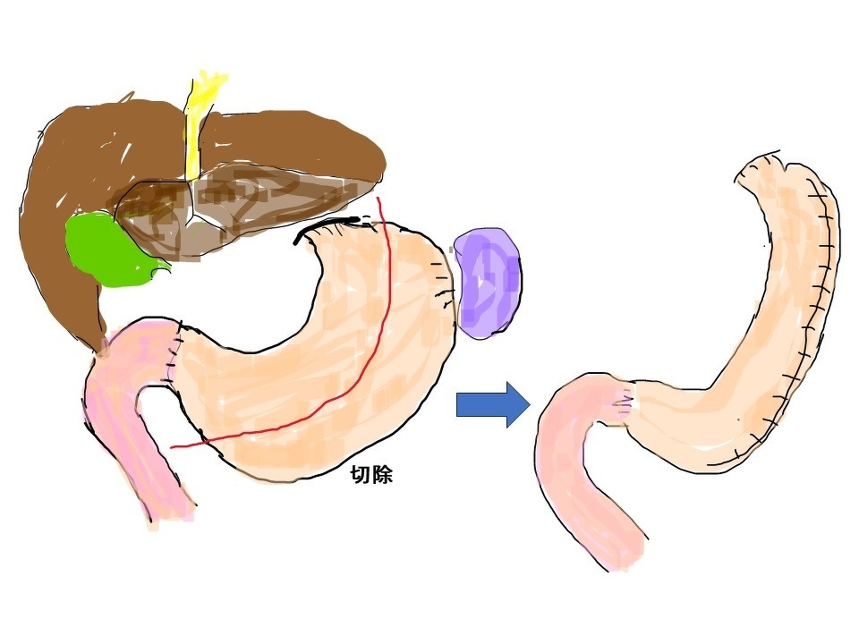 胃切除のイメージ